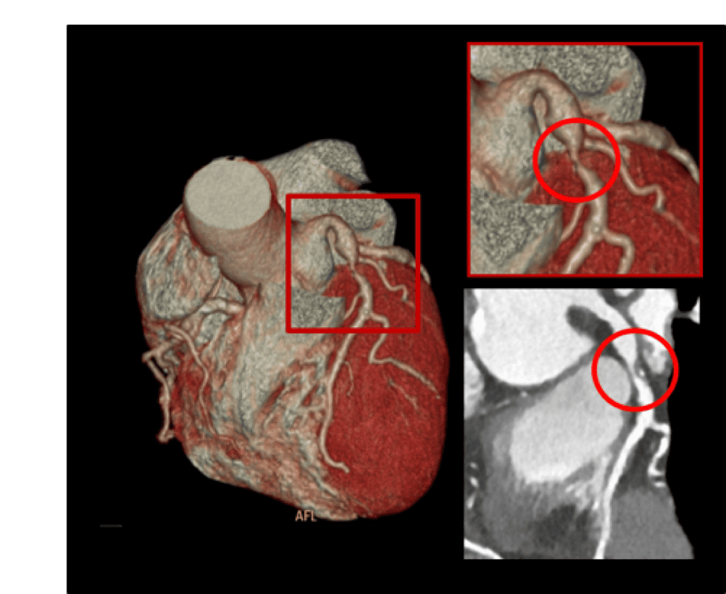 CT Stenose