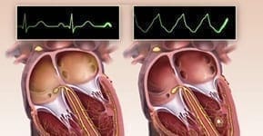 BlurbArrhythmie
