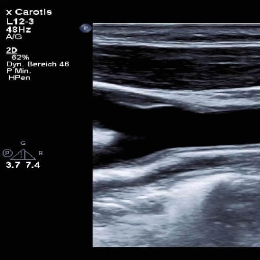 CarotisPlaque dffdg