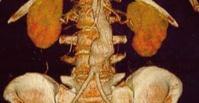 BlurbAortenaneurysma