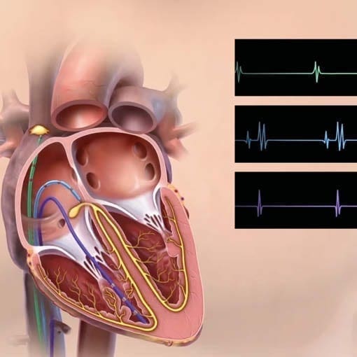 Vorhofarrhythmien Osypka Herzzentrum Munchen