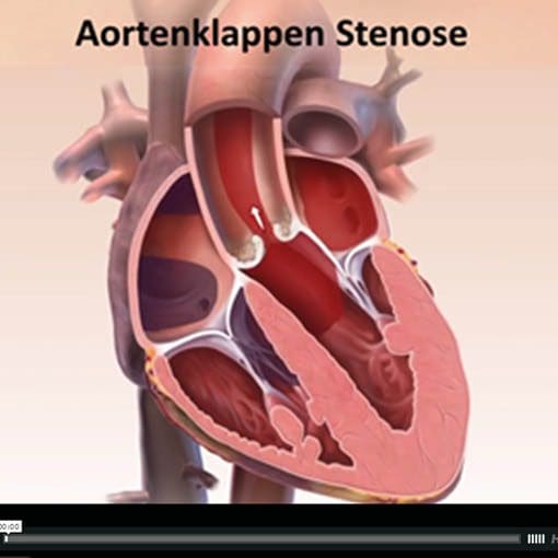 Aortenklappen-Stenose - Osypka Herzzentrum München