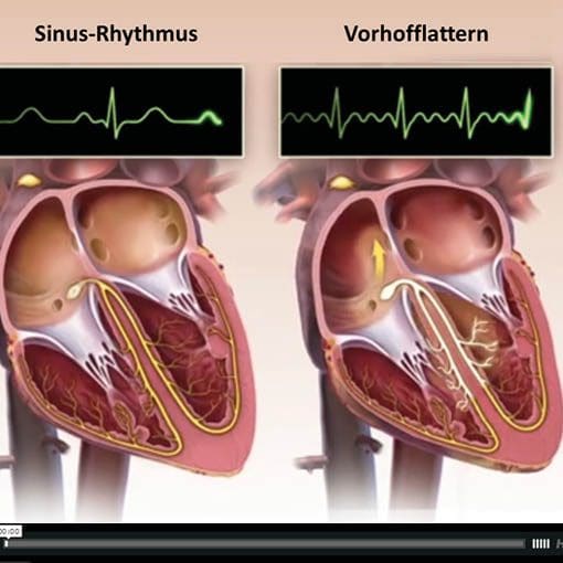 Vorhofflattern Osypka Herzzentrum München