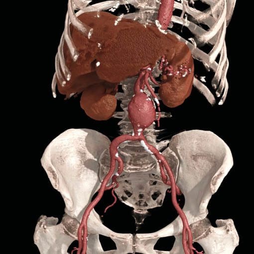 Herz-CT