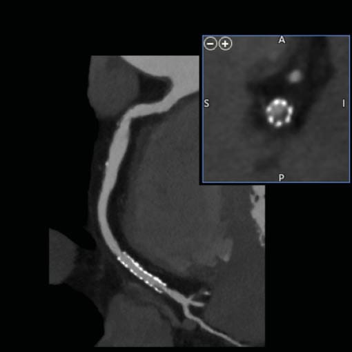 CT-Angiographie Herz (Cardio-CT)